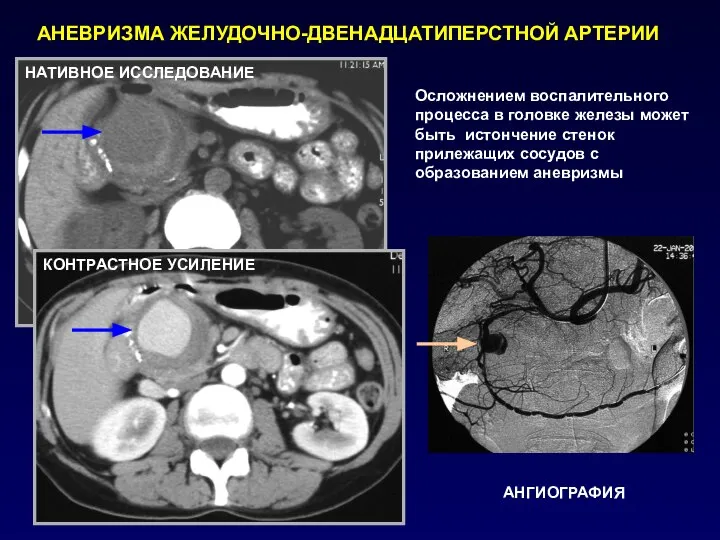 АНЕВРИЗМА ЖЕЛУДОЧНО-ДВЕНАДЦАТИПЕРСТНОЙ АРТЕРИИ Осложнением воспалительного процесса в головке железы может быть