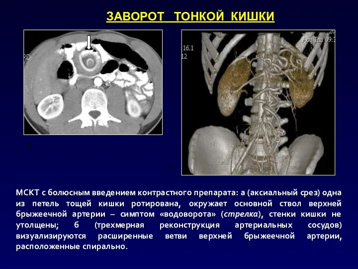 а б МСКТ с болюсным введением контрастного препарата: а (аксиальный срез)