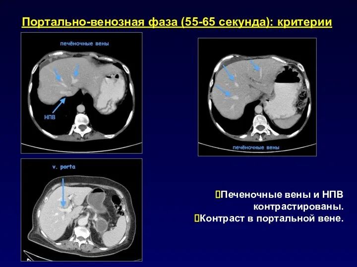 Портально-венозная фаза (55-65 секунда): критерии Печеночные вены и НПВ контрастированы. Контраст в портальной вене.