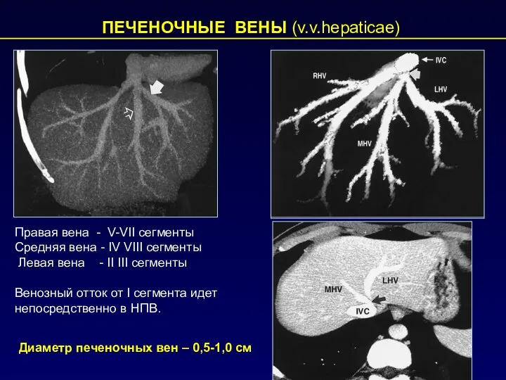 ПЕЧЕНОЧНЫЕ ВЕНЫ (v.v.hepaticae) Правая вена - V-VII сегменты Средняя вена -