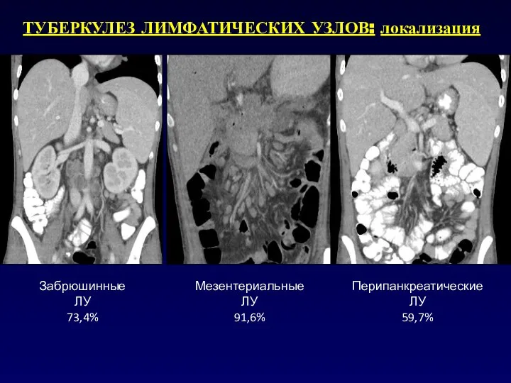 ТУБЕРКУЛЕЗ ЛИМФАТИЧЕСКИХ УЗЛОВ: локализация Забрюшинные ЛУ 73,4% Мезентериальные ЛУ 91,6% Перипанкреатические ЛУ 59,7%