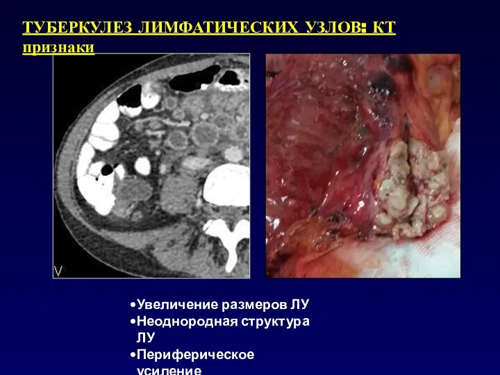 ТУБЕРКУЛЕЗ ЛИМФАТИЧЕСКИХ УЗЛОВ: КТ признаки Увеличение размеров ЛУ Неоднородная структура ЛУ Периферическое усиление