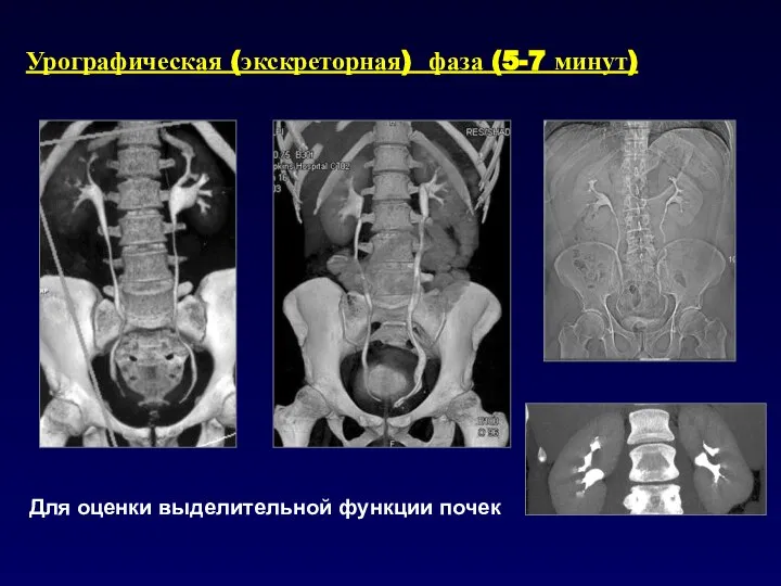 Урографическая (экскреторная) фаза (5-7 минут) Для оценки выделительной функции почек