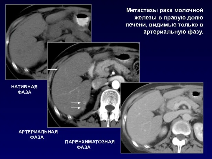 НАТИВНАЯ ФАЗА АРТЕРИАЛЬНАЯ ФАЗА ПАРЕНХИМАТОЗНАЯ ФАЗА Метастазы рака молочной железы в