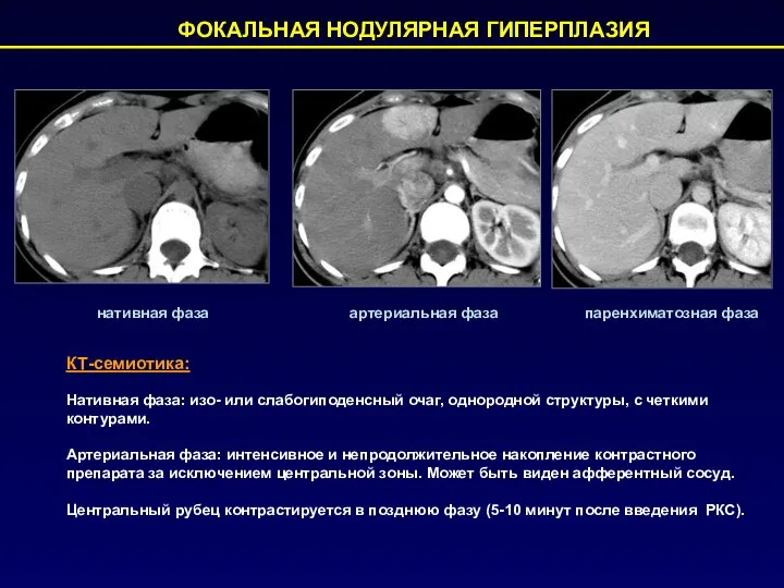 ФОКАЛЬНАЯ НОДУЛЯРНАЯ ГИПЕРПЛАЗИЯ КТ-семиотика: нативная фаза артериальная фаза Нативная фаза: изо-