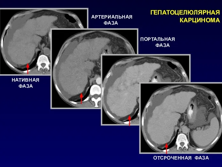 ГЕПАТОЦЕЛЮЛЯРНАЯ КАРЦИНОМА НАТИВНАЯ ФАЗА АРТЕРИАЛЬНАЯ ФАЗА ПОРТАЛЬНАЯ ФАЗА ОТСРОЧЕННАЯ ФАЗА