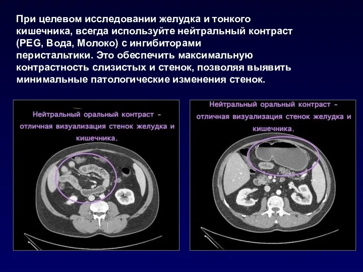 При целевом исследовании желудка и тонкого кишечника, всегда используйте нейтральный контраст