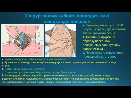 У хірургічному кабінеті проводять такі невідкладні операції: 1. Реанімаційні заходи: ШВЛ,