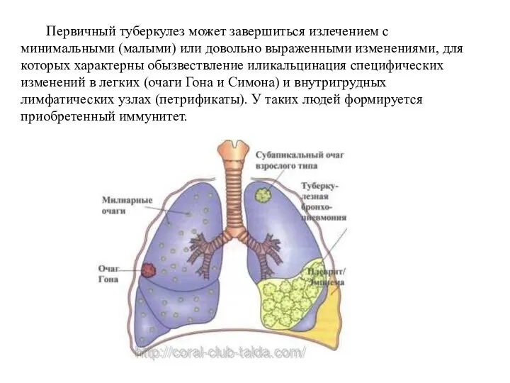 Первичный туберкулез может завершиться излечением с минимальными (малыми) или довольно выраженными