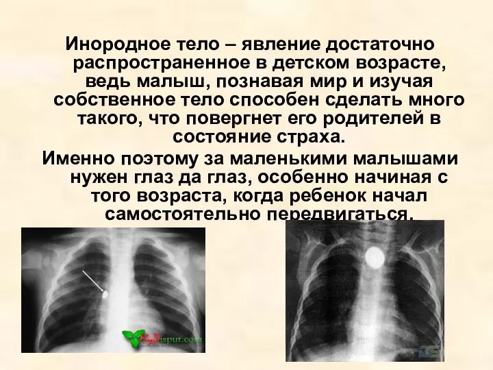 Инородное тело – явление достаточно распространенное в детском возрасте, ведь малыш,