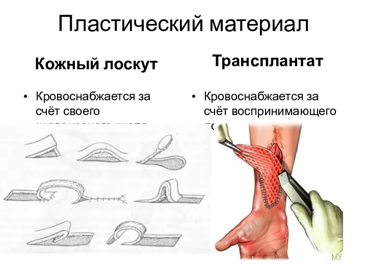 Пластический материал Кожный лоскут Кровоснабжается за счёт своего кровеносного русла Трансплантат Кровоснабжается за счёт воспринимающего ложа