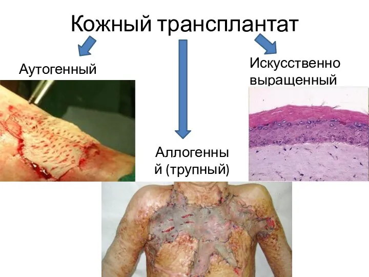 Кожный трансплантат Аутогенный Аллогенный (трупный) Искусственно выращенный