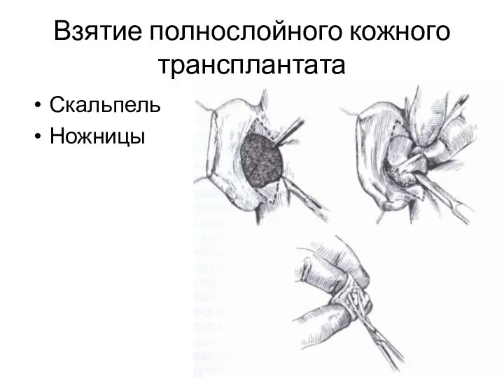 Взятие полнослойного кожного трансплантата Скальпель Ножницы