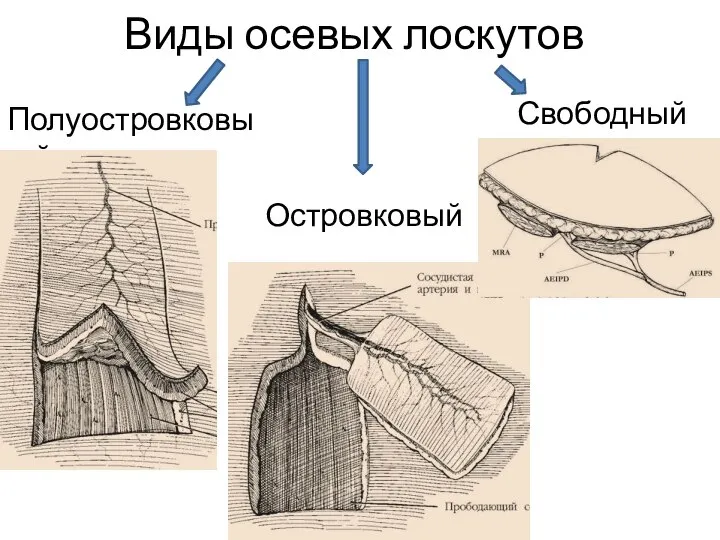 Виды осевых лоскутов Полуостровковый Островковый Свободный