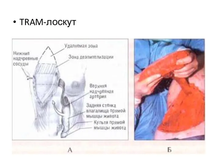 TRAM-лоскут