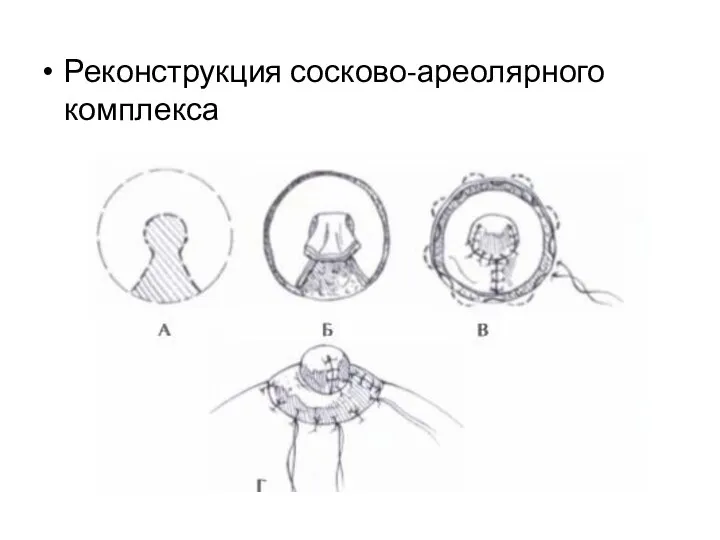 Реконструкция сосково-ареолярного комплекса