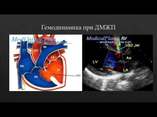 Гемодинамика при ДМЖП