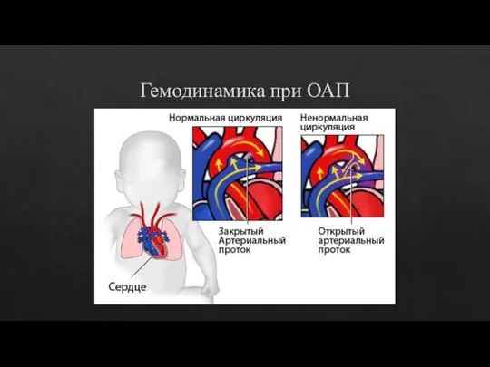 Гемодинамика при ОАП