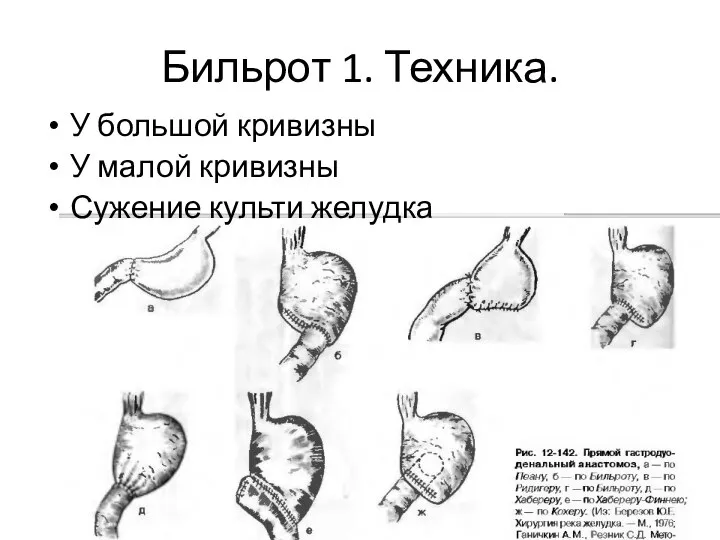 Бильрот 1. Техника. У большой кривизны У малой кривизны Сужение культи желудка