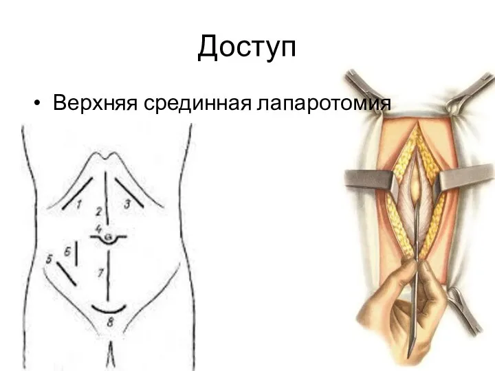 Доступ Верхняя срединная лапаротомия