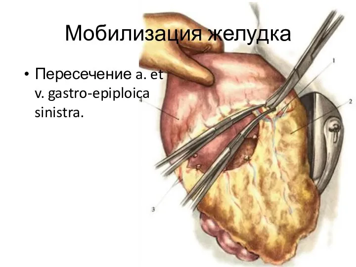 Мобилизация желудка Пересечение a. et v. gastro-epiploica sinistra.