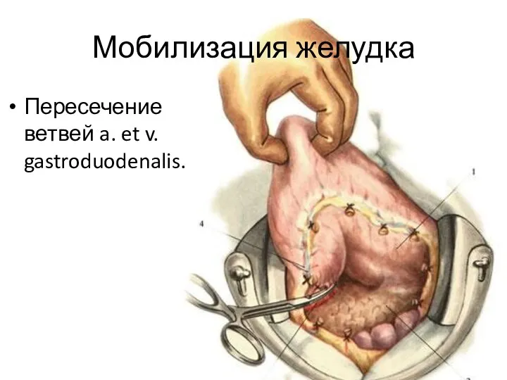 Мобилизация желудка Пересечение ветвей a. et v. gastroduodenalis.