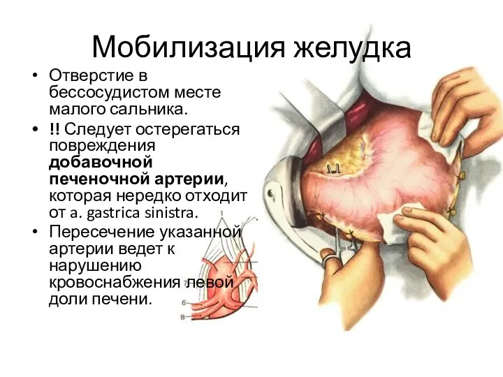 Мобилизация желудка Отверстие в бессосудистом месте малого сальника. !! Следует остерегаться