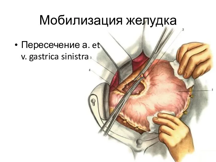 Мобилизация желудка Пересечение а. et v. gastrica sinistra