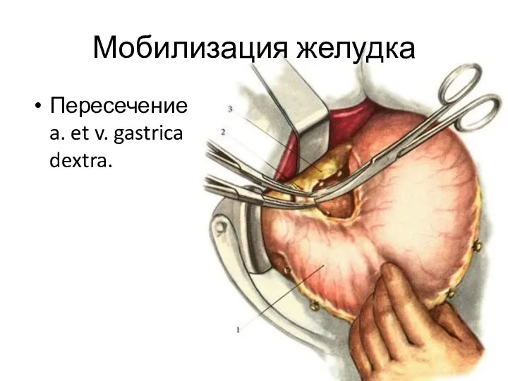 Мобилизация желудка Пересечение a. et v. gastrica dextra.