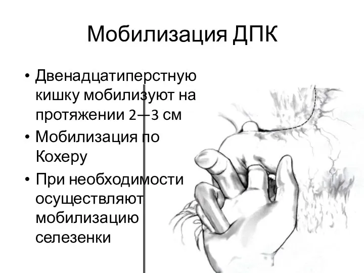 Мобилизация ДПК Двенадцатиперстную кишку мобилизуют на протяжении 2—3 см Мобилизация по