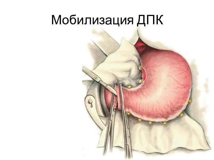 Мобилизация ДПК