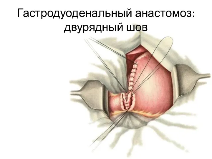 Гастродуоденальный анастомоз: двурядный шов