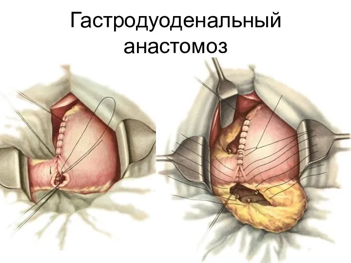 Гастродуоденальный анастомоз