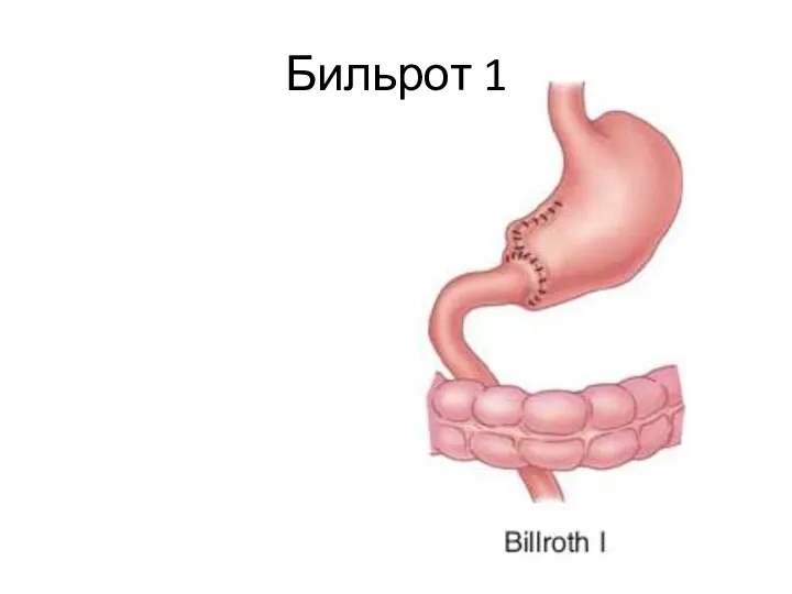 Бильрот 1