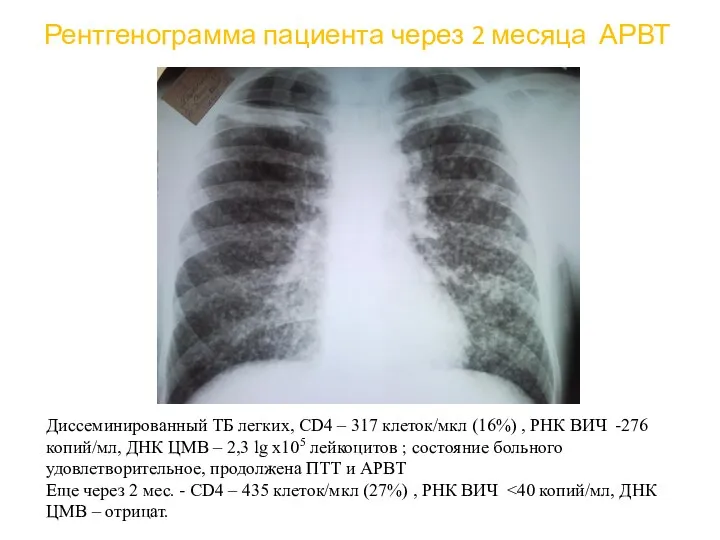 Рентгенограмма пациента через 2 месяца АРВТ Диссеминированный ТБ легких, CD4 –