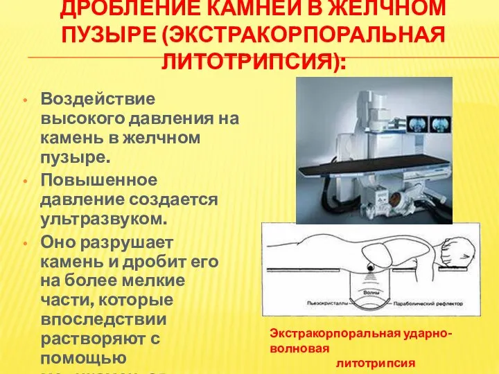 ДРОБЛЕНИЕ КАМНЕЙ В ЖЕЛЧНОМ ПУЗЫРЕ (ЭКСТРАКОРПОРАЛЬНАЯ ЛИТОТРИПСИЯ): Воздействие высокого давления на