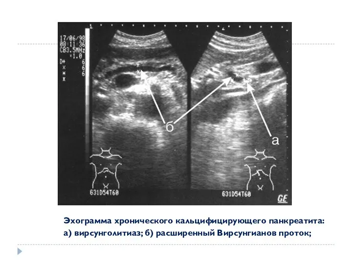 Эхограмма хронического кальцифицирующего панкреатита: а) вирсунголитиаз; б) расширенный Вирсунгианов проток;