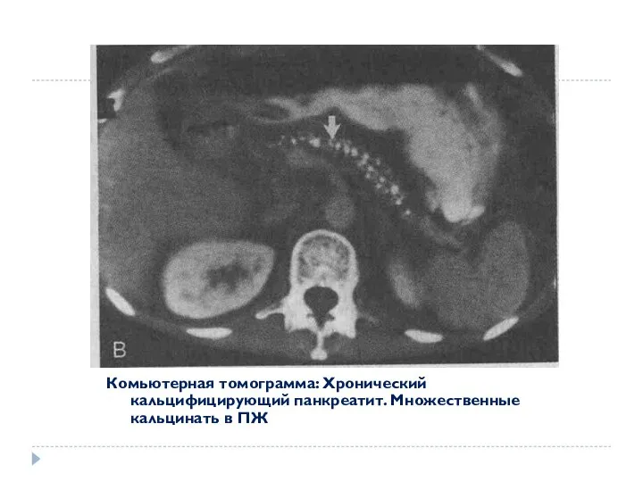 Комьютерная томограмма: Хронический кальцифицирующий панкреатит. Множественные кальцинать в ПЖ