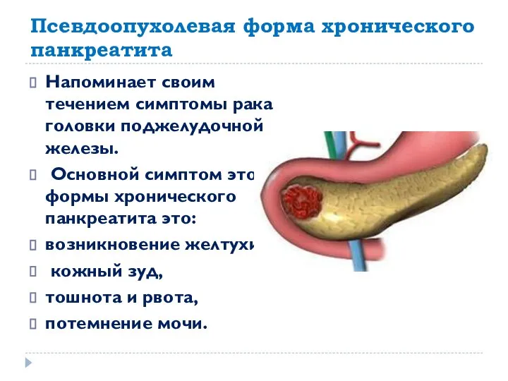 Псевдоопухолевая форма хронического панкреатита Напоминает своим течением симптомы рака головки поджелудочной