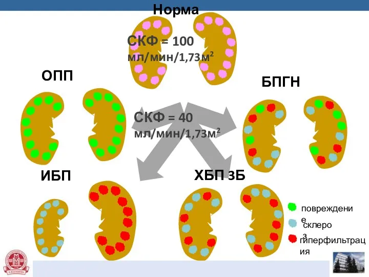повреждение склероз гиперфильтрация ОПП ИБП БПГН ХБП 3Б Норма СКФ =