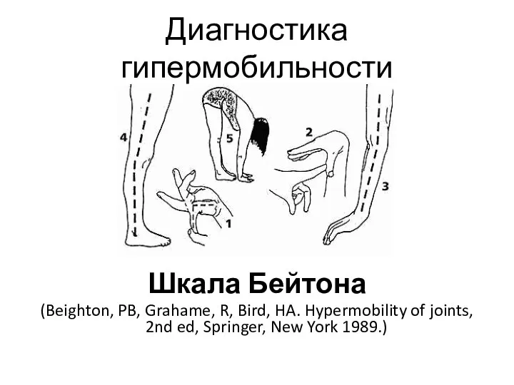 Диагностика гипермобильности Шкала Бейтона (Beighton, PB, Grahame, R, Bird, HA. Hypermobility