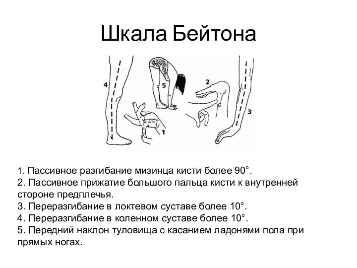 Шкала Бейтона 1. Пассивное разгибание мизинца кисти более 90°. 2. Пассивное