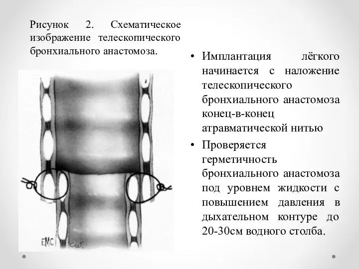 Имплантация лёгкого начинается с наложение телескопического бронхиального анастомоза конец-в-конец атравматической нитью