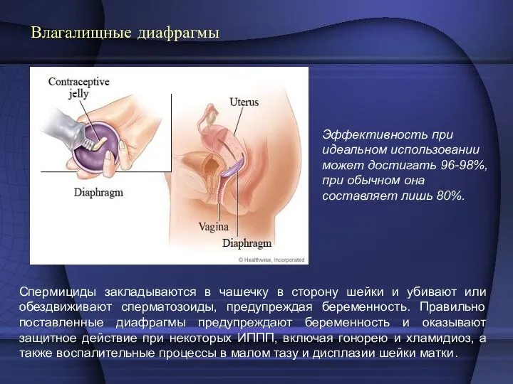 Влагалищные диафрагмы Спермициды закладываются в чашечку в сторону шейки и убивают