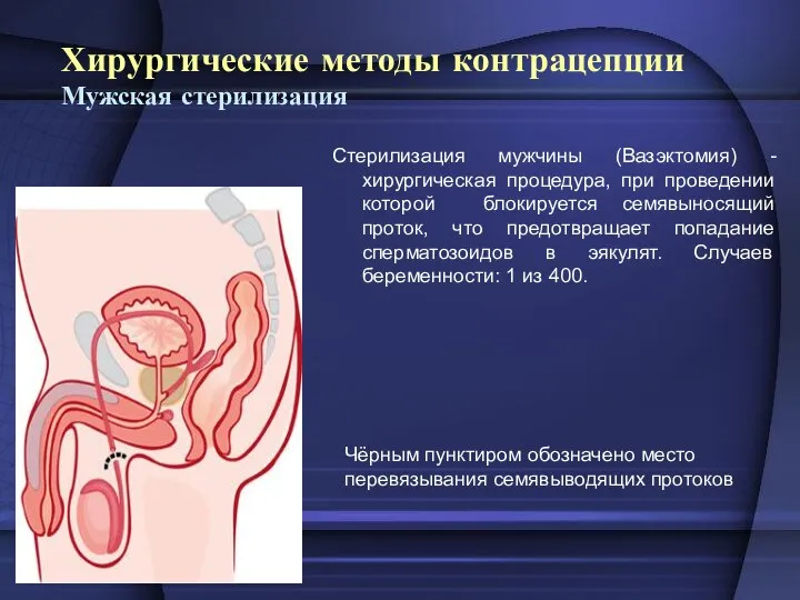 Хирургические методы контрацепции Мужская стерилизация Стерилизация мужчины (Вазэктомия) - хирургическая процедура,