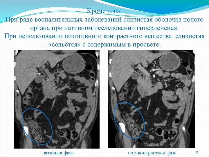 Кроме того! При ряде воспалительных заболеваний слизистая оболочка полого органа при