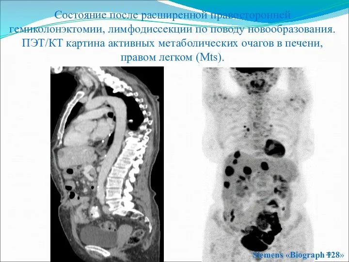 Siemens «Biograph 128» Состояние после расширенной правосторонней гемиколонэктомии, лимфодиссекции по поводу
