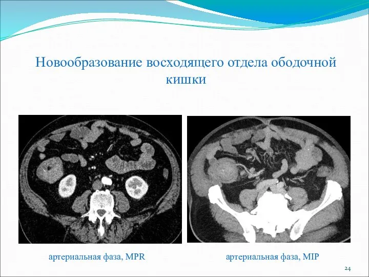 Новообразование восходящего отдела ободочной кишки артериальная фаза, MPR артериальная фаза, MIP