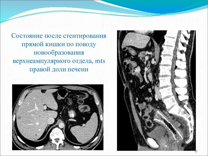 Состояние после стентирования прямой кишки по поводу новообразования верхнеампулярного отдела, mts правой доли печени