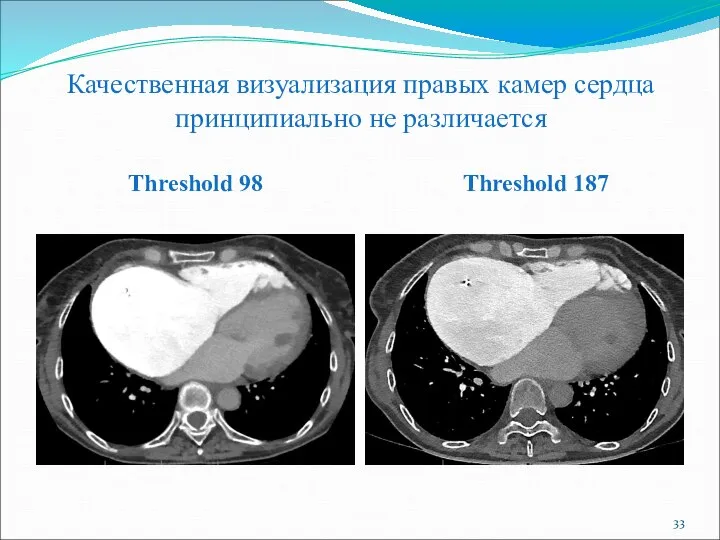 Качественная визуализация правых камер сердца принципиально не различается Threshold 98 Threshold 187